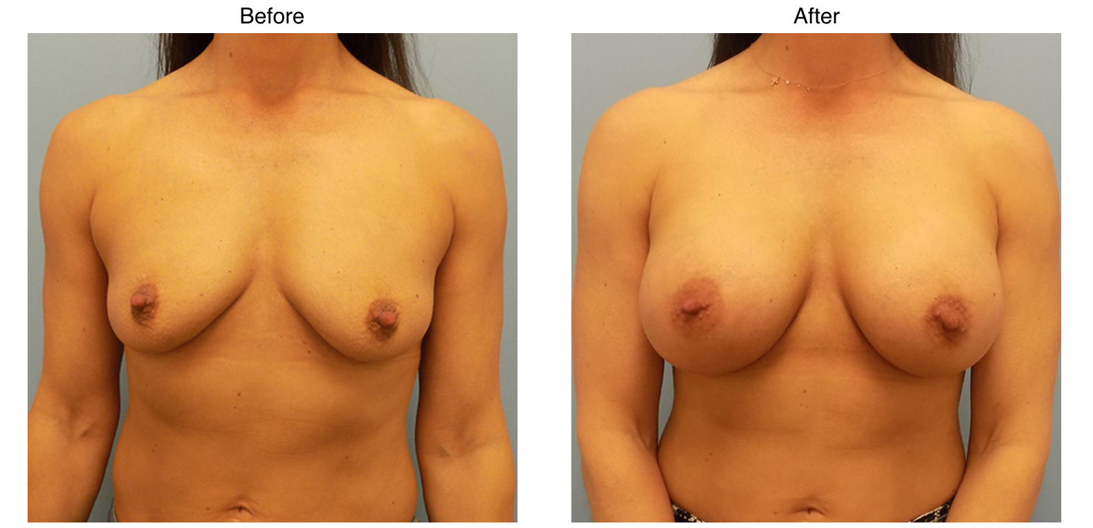 Breast Augmentation & Implants in Baton Rouge, LA
