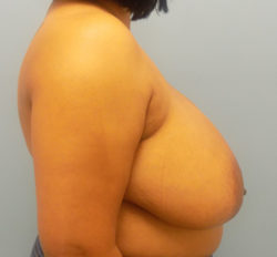 Breast Reduction - Before and After