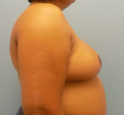 Breast Reduction - Before and After