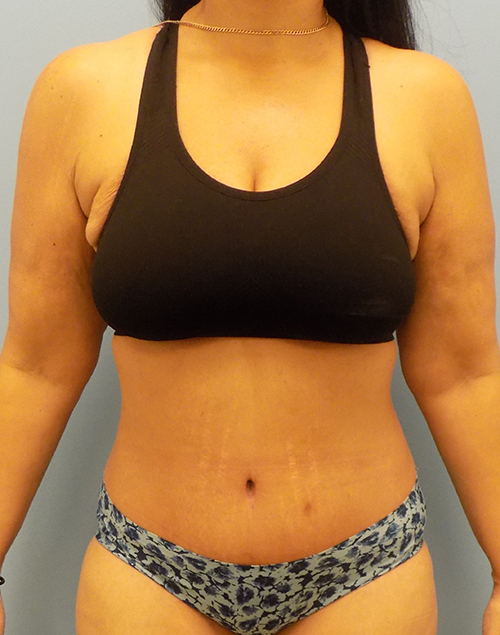 Abdominoplasty (Tummy Tuck) - Before and After