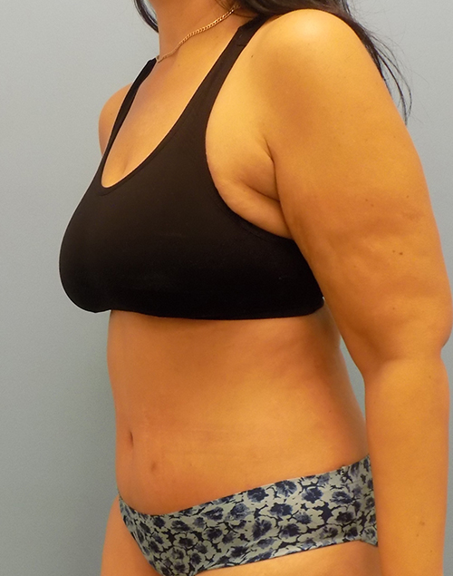 Abdominoplasty (Tummy Tuck) - Before and After