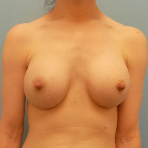 Breast Augmentation - Before and After