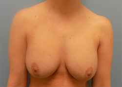 Implant-Based Breast Reconstruction - Before & After