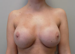 Implant-Based Breast Reconstruction - Before & After