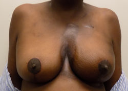 Oncoplastic Breast Surgery - Before & After