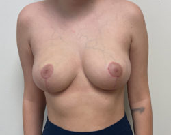 Mastopexy (Breast Lift) - Before and After Implants