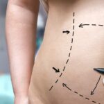Prepping for a tummy tuck